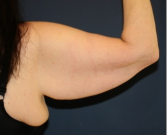 Feel Beautiful - Arm Reduction 210 - Before Photo